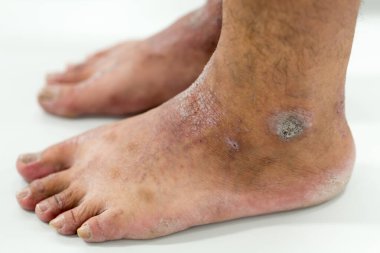 Atopik deri iltihabı (Atopedik egzama), bir tür deri iltihabı (dermatit).).