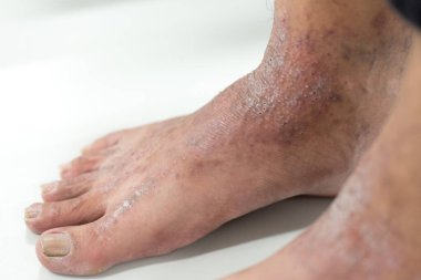 Atopik deri iltihabı (Atopedik egzama), bir tür deri iltihabı (dermatit).).