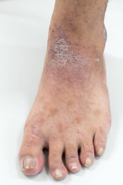 Atopik deri iltihabı (Atopedik egzama), bir tür deri iltihabı (dermatit).).