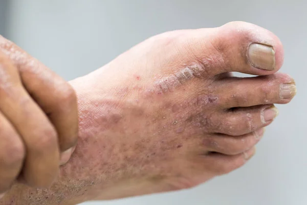 Físico Dermatite Atópica Também Conhecido Como Eczema Atópico Tipo Inflamação — Fotografia de Stock