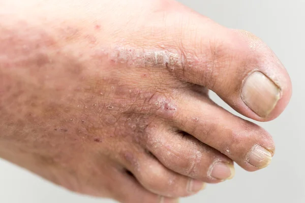 Een Fysieke Van Atopic Dermatitis Ook Bekend Als Atopisch Eczeem — Stockfoto