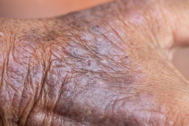 Atopik deri iltihabı (Atopedik egzama), bir tür deri iltihabı (dermatit).).