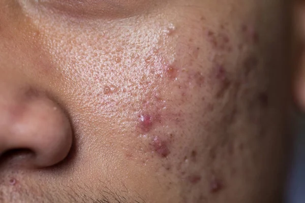 Hintergründe Von Hautverletzungen Durch Akne Gesicht Der Klinik — Stockfoto