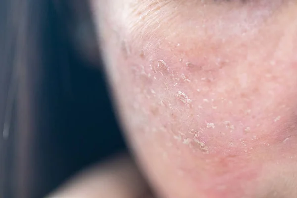 Antecedentes Lesões Pele Causadas Pela Acne Rosto Clínica — Fotografia de Stock