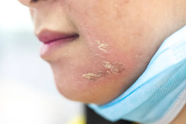 临床上痤疮引起的皮肤病变的背景 — 图库照片