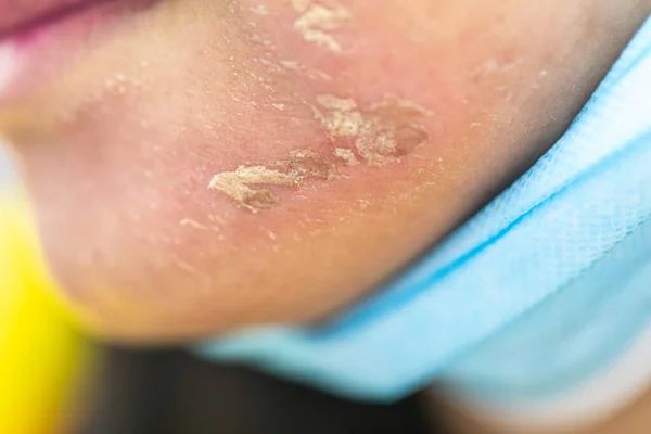 Antecedentes Lesões Pele Causadas Pela Acne Rosto Clínica — Fotografia de Stock