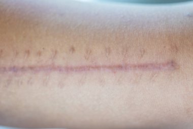 Yara izi, deri yaralanmasından sonra normal derinin yerini alan lifli bir dokudur..