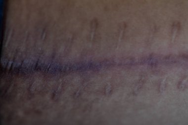 Yara izi, deri yaralanmasından sonra normal derinin yerini alan lifli bir dokudur..