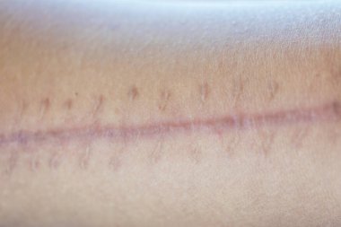 Yara izi, deri yaralanmasından sonra normal derinin yerini alan lifli bir dokudur..