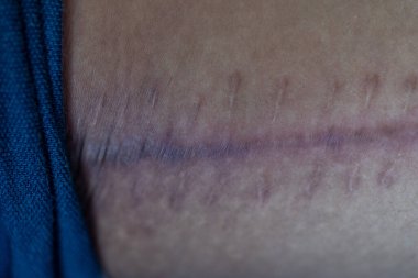 Yara izi, deri yaralanmasından sonra normal derinin yerini alan lifli bir dokudur..