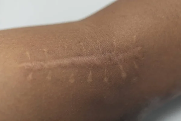 A scar is an area of fibrous tissue that replaces normal skin after an injury on skin.