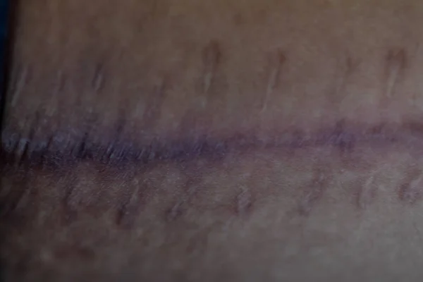 A scar is an area of fibrous tissue that replaces normal skin after an injury on skin.