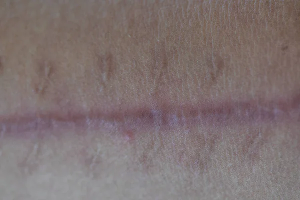 A scar is an area of fibrous tissue that replaces normal skin after an injury on skin.