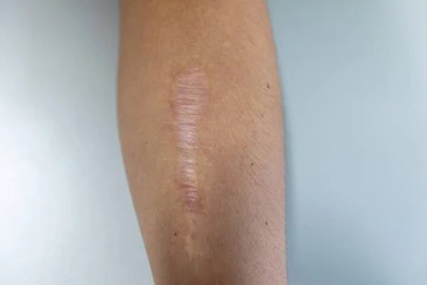 Una Cicatriz Área Tejido Fibroso Que Reemplaza Piel Normal Después — Foto de Stock