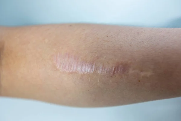 A scar is an area of fibrous tissue that replaces normal skin after an injury on skin.