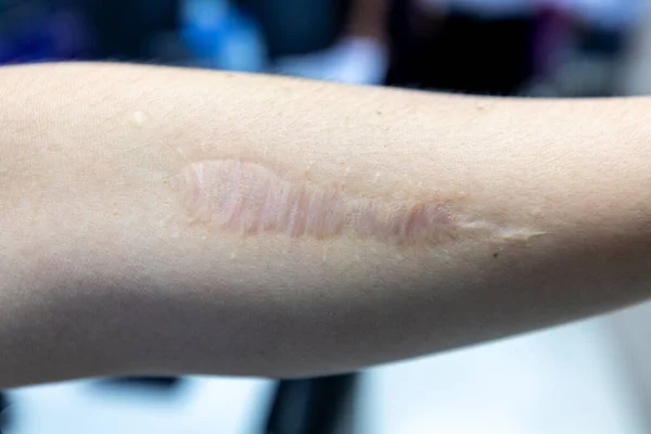 A scar is an area of fibrous tissue that replaces normal skin after an injury on skin.