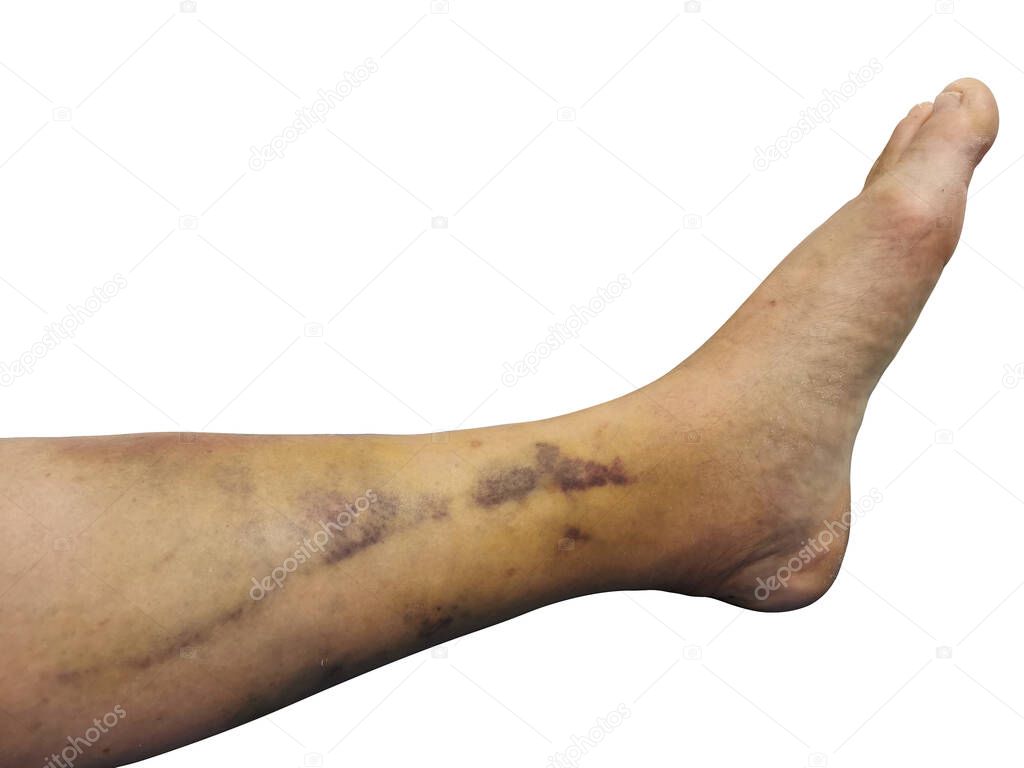 Contusion on leg from an impact injury isolated on white background.