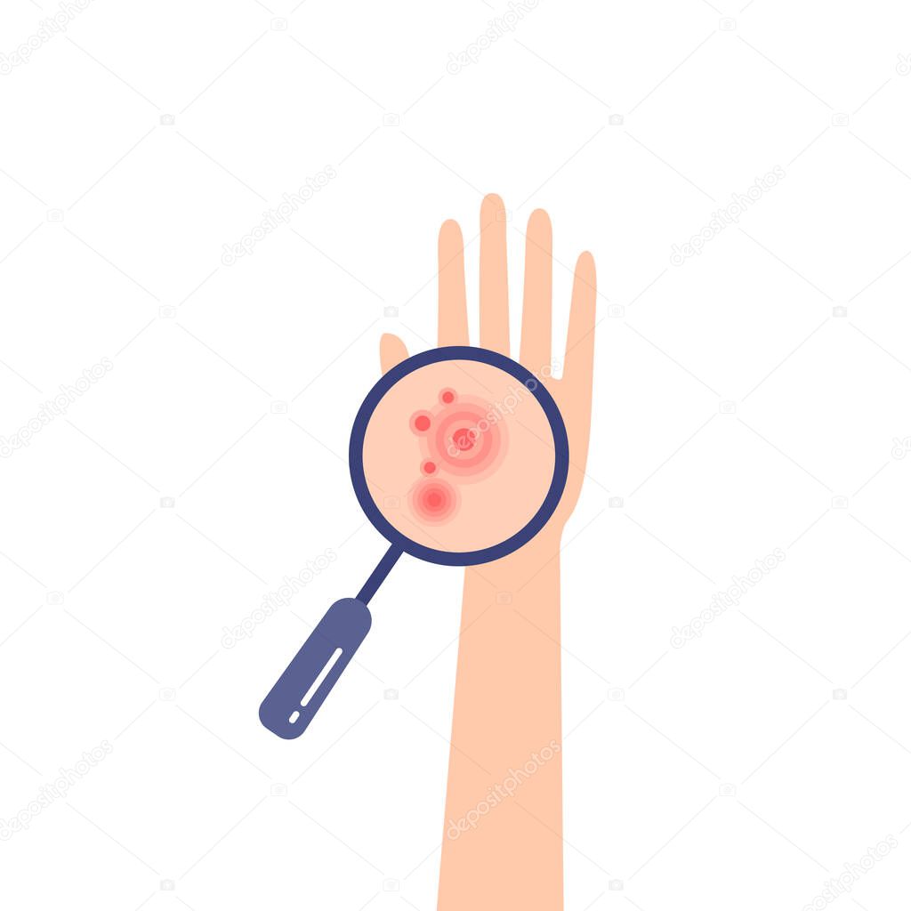 medical examination of redness on the arm. increased scheme eczema on human hand. lab diagnostic patient with an allergic reaction like an dermatitis. flat image of skin disease and red rash symptoms
