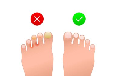Sorun ve sağlıklı ayak ikonu. Alerjisi, deri iltihabı ve unguyumu olan bir hasta. Deri hastalığı ve kızarıklığın görüntüsü. Tıbbi siteler ve uygulamalar için bir sembol. Basit renk işareti beyazda izole edildi