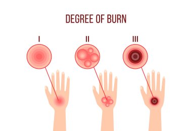 Farklı yanık derecelerinin bilgi grafikleri. Ellerin derisindeki yaraları gösteren bir afiş. Kırmızı üst deri semptomu. Siteler için ilk yardım, uygulamalar. beyaz arkaplanda izole edilmiş düz renk işareti.