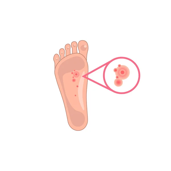 足の湿疹の増加 患者の足を皮膚炎のようなアレルギー反応で表現します 皮膚病や発疹のイメージです 医療現場やアプリのシンボルです 白地に隔離された — ストックベクタ