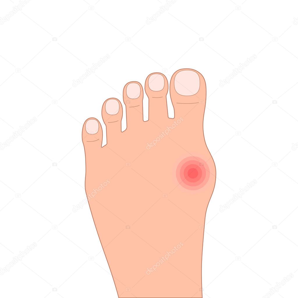 Flat foot disease color icon. concept of cosmetics and procedures for feet care, medical problem, pain, painful bunion. hospital symbol for print, logo, site. simple sign isolated on white background