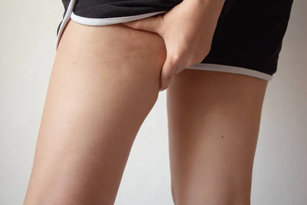 Mulher Jovem Segurando Empurrando Pele Das Pernas Celulite Casca Laranja — Fotografia de Stock