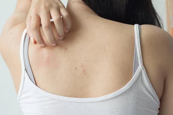 アジアの女性はにきびスポットと赤い傷で彼女の背中を示す若い女性 — ストック写真