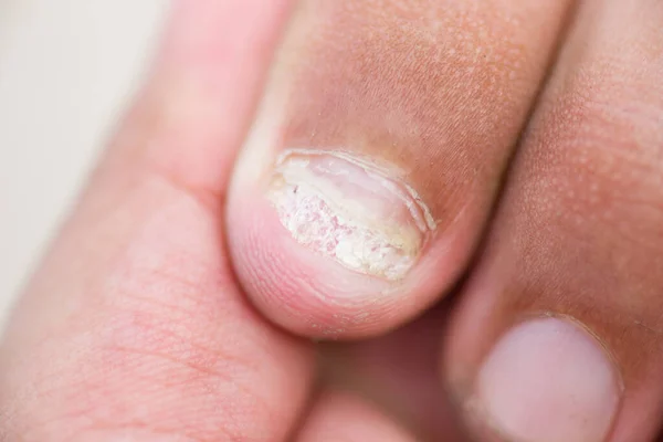 手指指甲上的真菌感染 — 图库照片