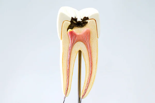 Modelo Dientes Con Caries Fondo Blanco — Foto de Stock