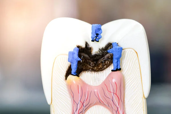 Cientista Pessoas Miniatura Trabalho Com Modelo Dente Cariado — Fotografia de Stock