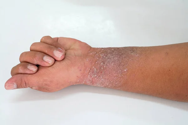 Eczema Presents Hand Palms — Stock Photo, Image
