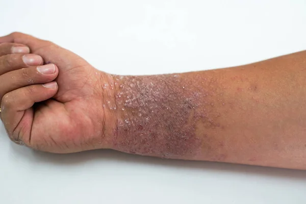 Eczema Apresenta Mão Palmas — Fotografia de Stock