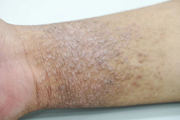 Eczema Presents Hand Skin Palms — Stock Photo, Image