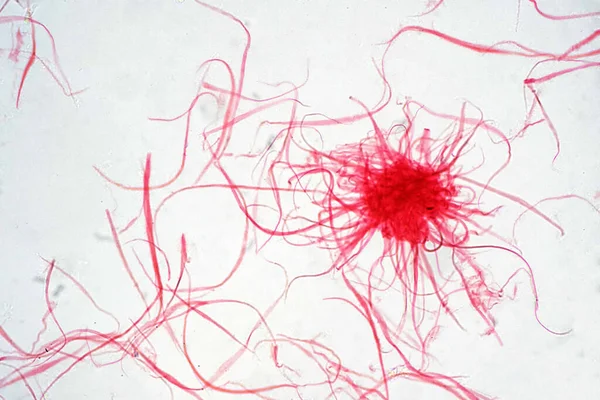 Kanserli Hücre Mikroskop Altında Tıp Bilimi Geçmişi Kavramı — Stok fotoğraf