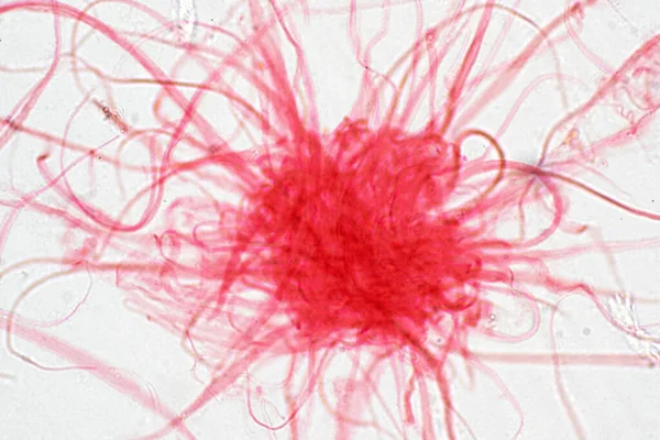 Ракові Клітини Людини Під Мікроскопом Походження Медичної Науки — стокове фото