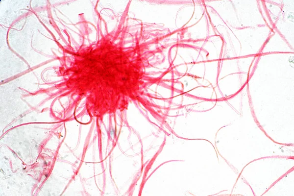 Komórka Nowotworowa Ludzi Pod Mikroskopem Koncepcja Tła Medycyny — Zdjęcie stockowe