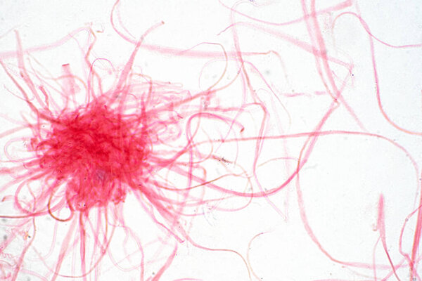 Cancer Cell in human under the microscope view. Medical science background concept.