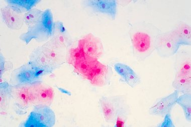 Mikroskop altında insan rahim boynunda sineksi epitel hücreler. Pap smear testi kadınlarda rahim kanseri için yapılan bir testtir..