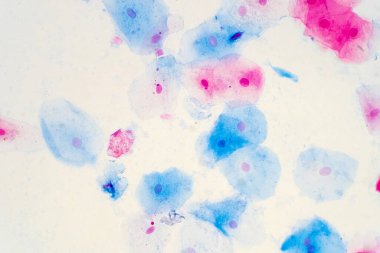 Mikroskop altında insan rahim boynunda sineksi epitel hücreler. Pap smear testi kadınlarda rahim kanseri için yapılan bir testtir..