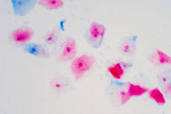 Dlaždicové Epitelové Buňky Lidského Děložního Čípku Pod Mikroskopem Pap Stěr — Stock fotografie