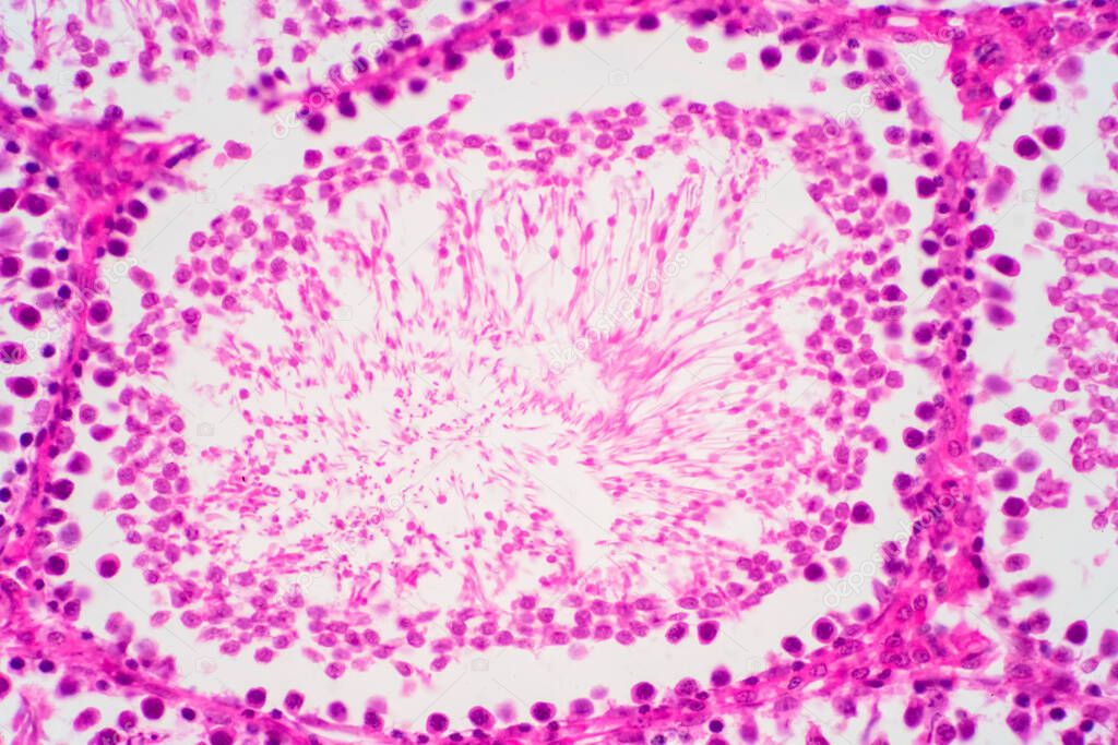 Human sperm in the testis morphology under microscope. Micrograph showing spermatozoon for pathology education.