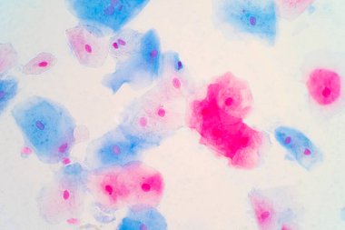 Mikroskop altında insan rahim boynunda sineksi epitel hücreler. Pap smear testi kadınlarda rahim kanseri için yapılan bir testtir..