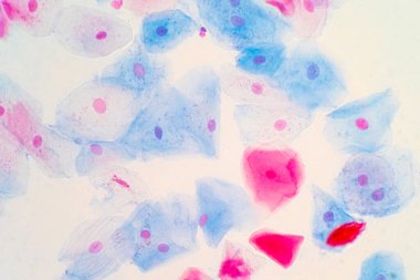 Mikroskop altında insan rahim boynunda sineksi epitel hücreler. Pap smear testi kadınlarda rahim kanseri için yapılan bir testtir..