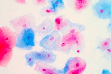 Mikroskop altında insan rahim boynunda sineksi epitel hücreler. Pap smear testi kadınlarda rahim kanseri için yapılan bir testtir..