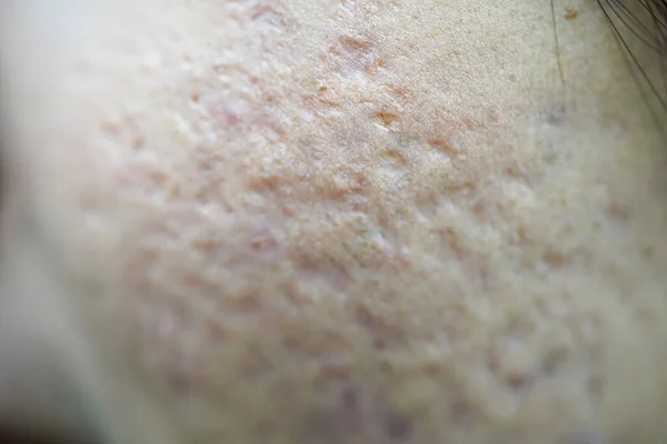 Problematische Haut Mit Tiefen Akne Narben Auf Der Wange Konzepte — Stockfoto