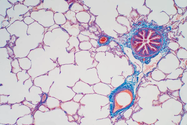 Emberi Tüdőszövet Mikroszkóp Alatt Tüdő Emberi Légzőrendszer Szervei Humán Patológiai — Stock Fotó