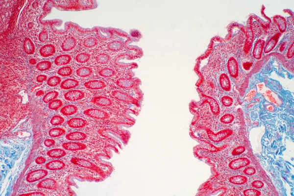 Colon Biopsy Colonoscopy Pathology Report Describes Normal Colonic Mucosa Fragment — Stock Photo, Image