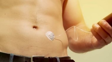 İnsülin pompası karnına bağlı ve elinde insülin pompası tutan diyabetik adam. Diyabet konsepti.