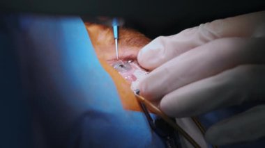 Lazer görüş düzeltmesi. Bir hasta ve bir cerrah ekibi göz ameliyatı sırasında ameliyathanede. Göz spekulumu. Lazer tedavisi. Hasta steril koruma altında.